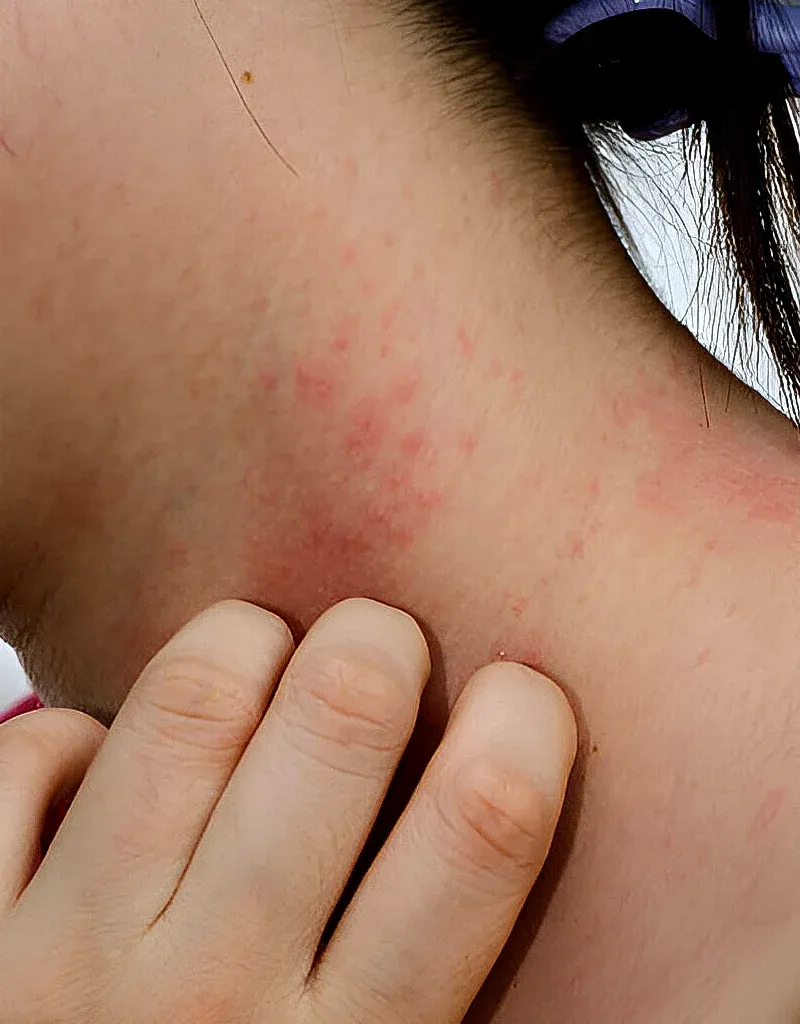 imgi_100_Common-Rashes-We-Treat